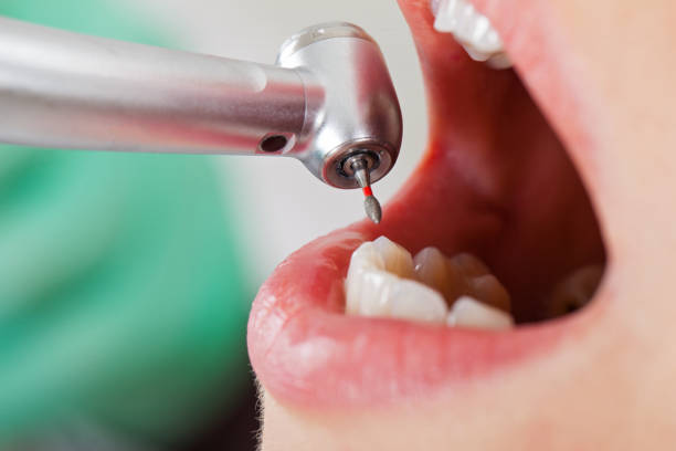 Urgent Tooth Repair in MD